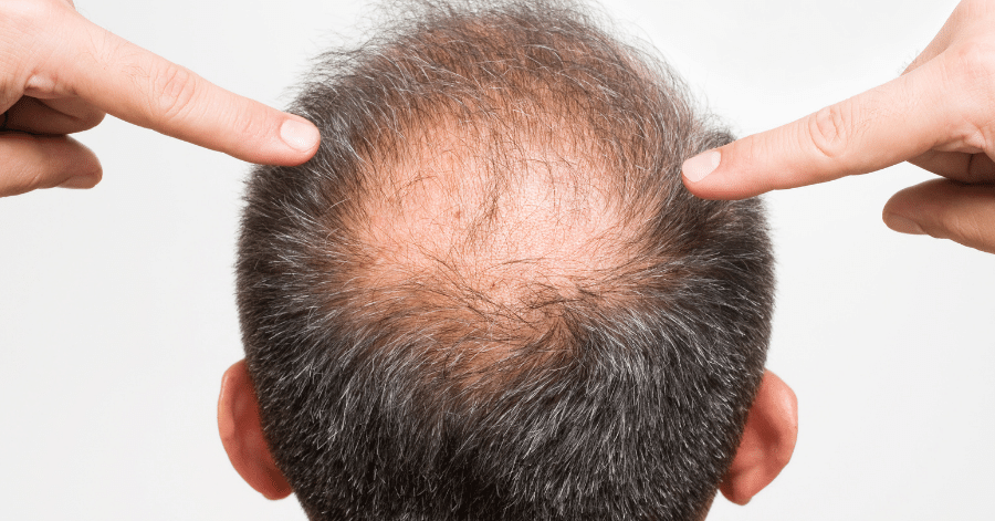 Procapil Hair Serum: Benefits, Side Effects