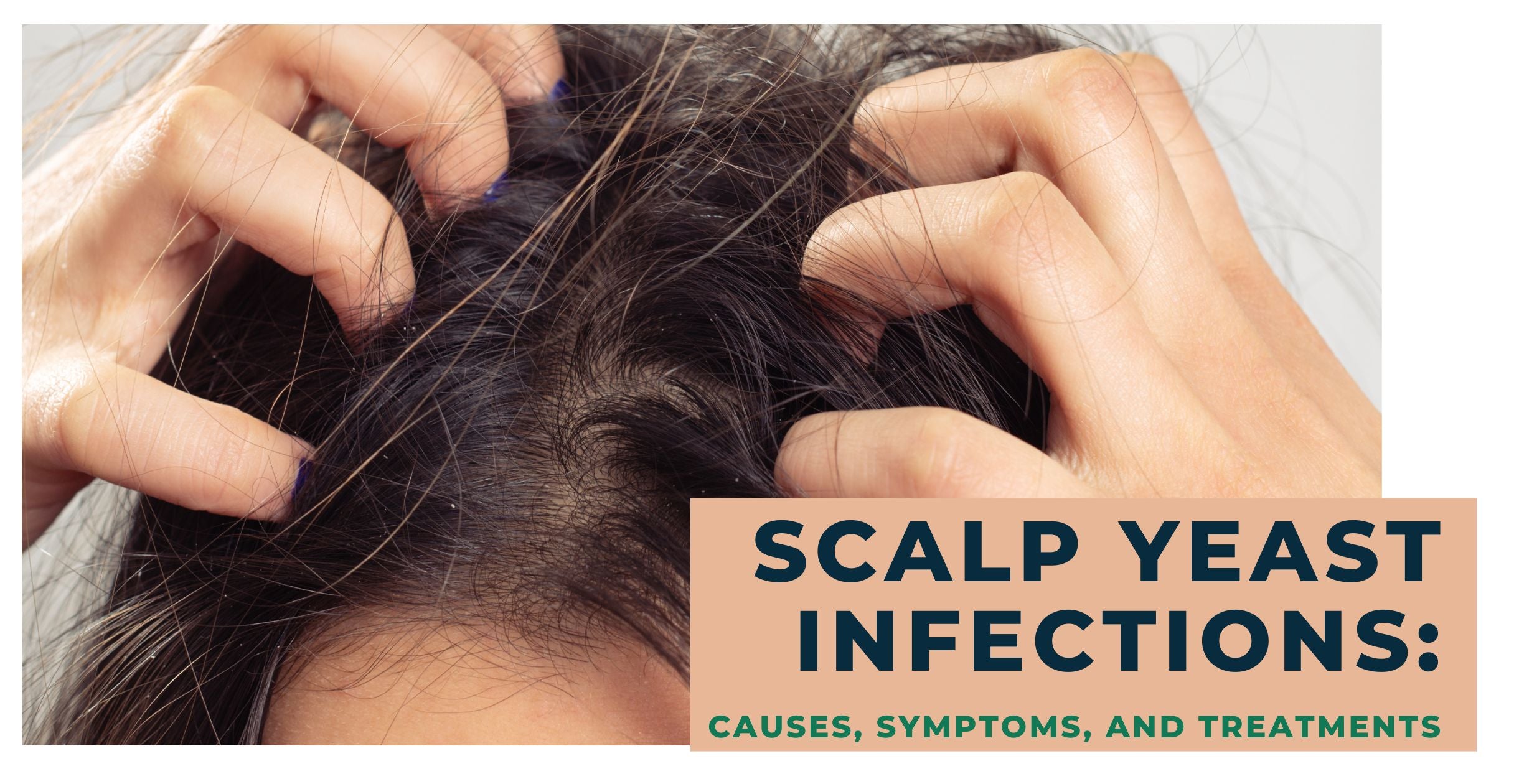 Scalp Yeast Infections Causes, Symptoms, and Treatments   Clinikally