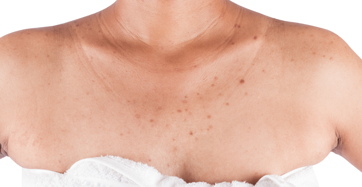 Acne - treatments, causes and prevention