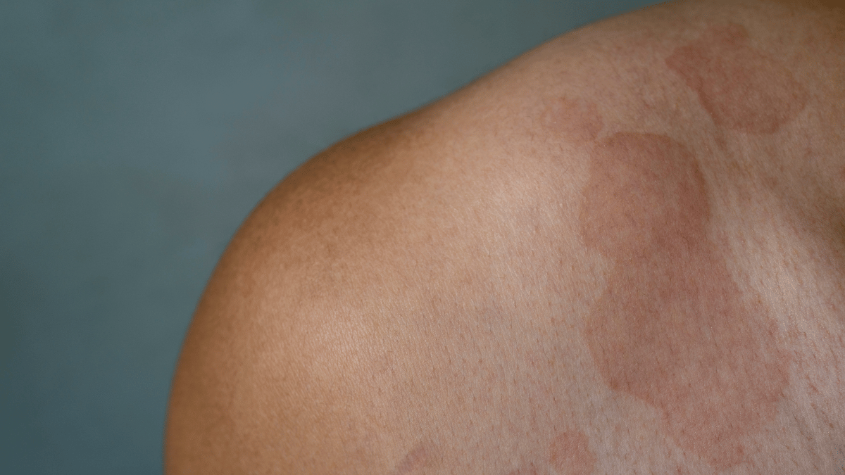 Rash in between breasts comes and goes