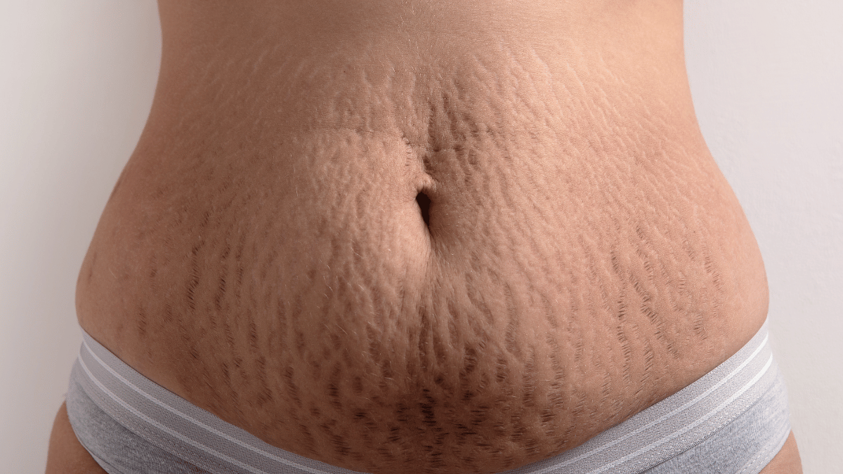 Stretch marks on breasts: Types, treatment options, and risk factors