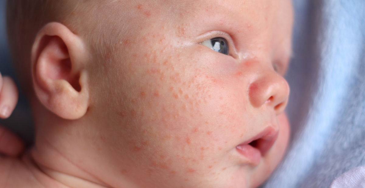 baby-acne-causes-symptoms-treatments-clinikally