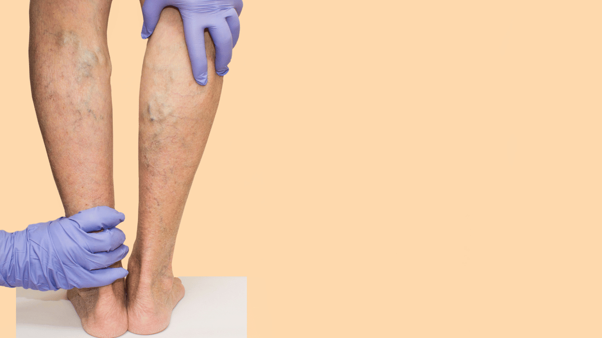 Why Do Varicose Veins Cause Skin Changes?: Center for Varicose