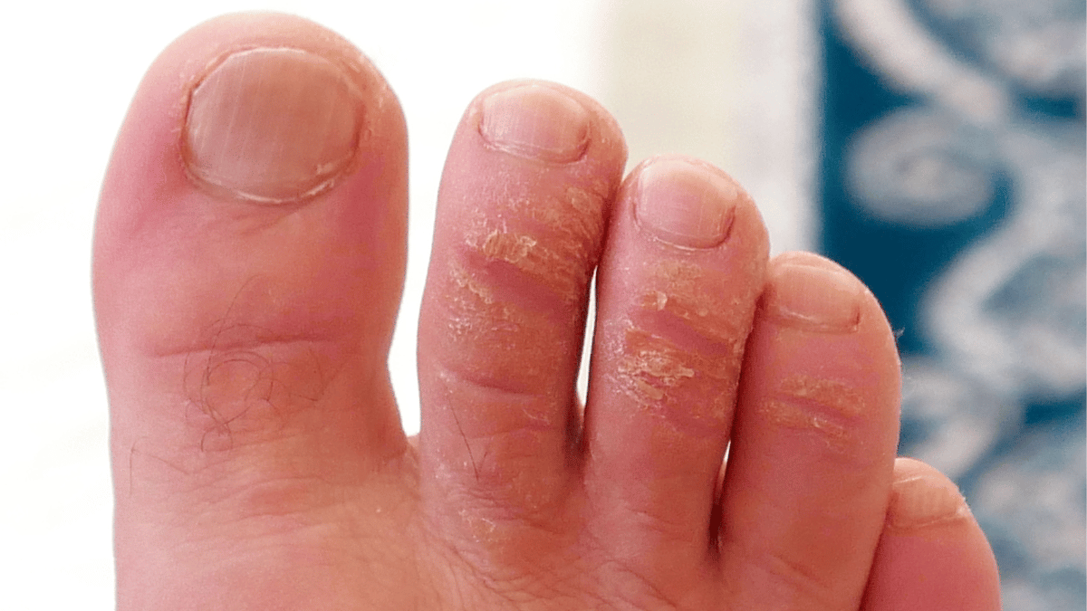 Corn vs. Callus: Body Parts, How They Form, Removal
