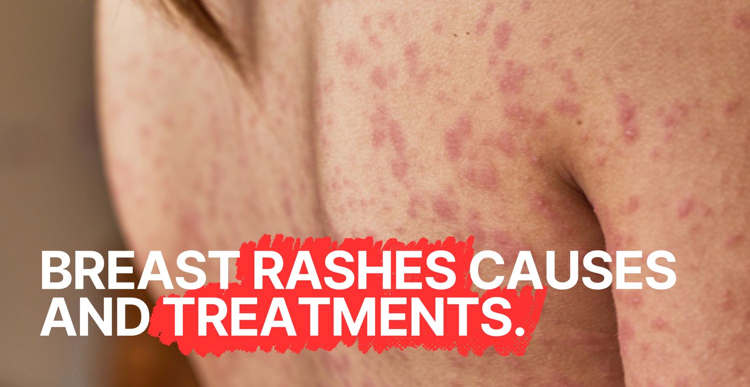 Breast Rashes Causes and Treatments: What You Need to Know