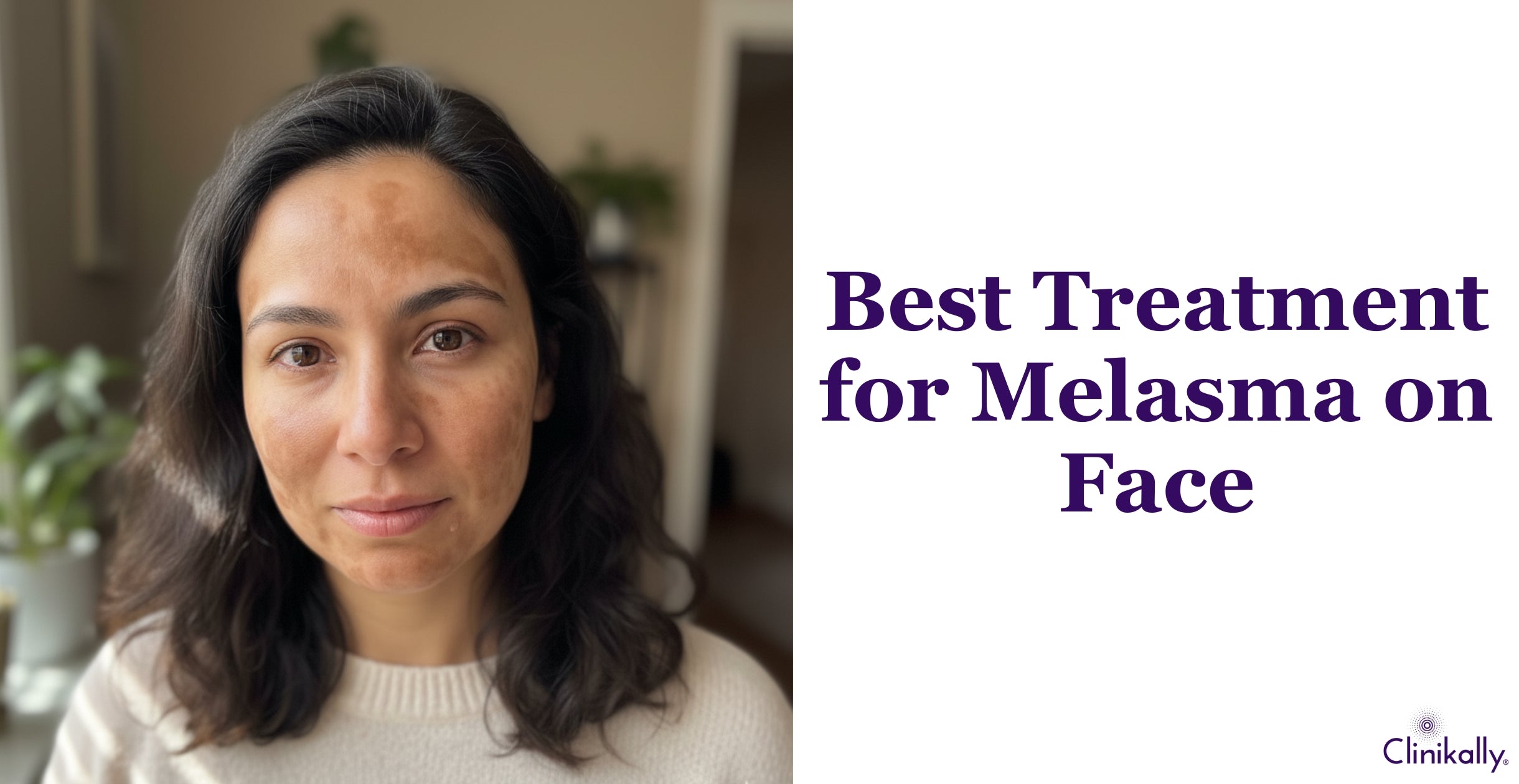 What Causes Melasma and How to Treat It Effectively