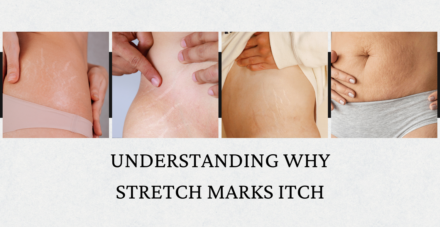 Understanding Why Stretch Marks Itch