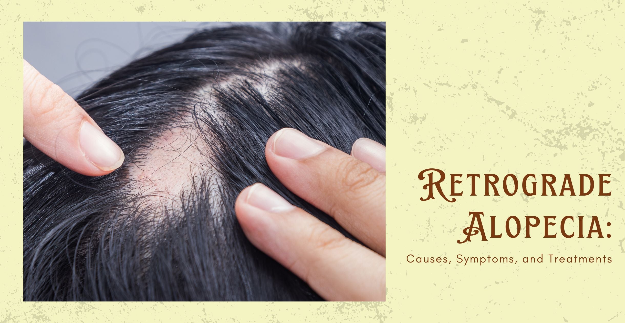 Retrograde Alopecia: Causes, Symptoms, and Treatments