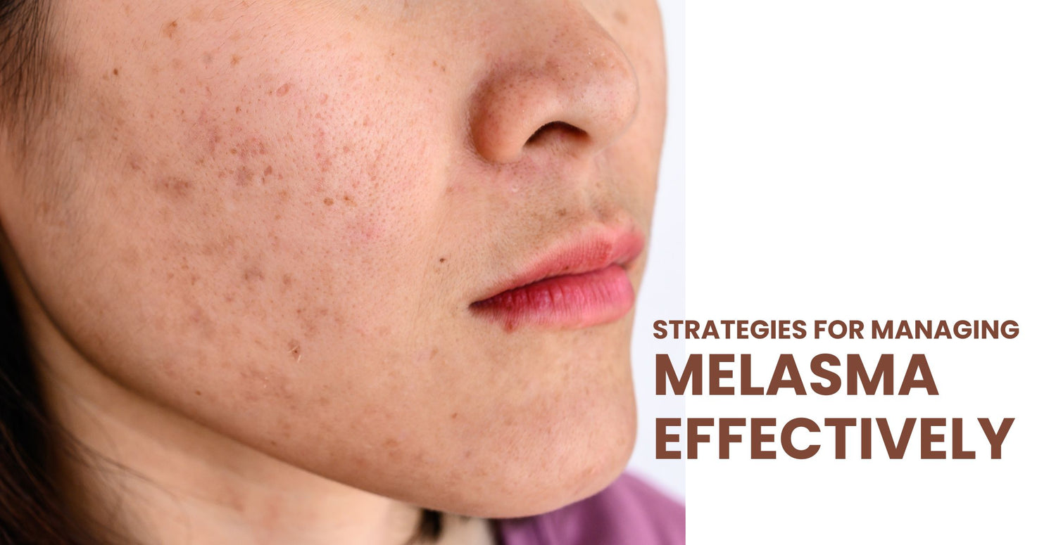 Strategies for Managing Melasma Effectively