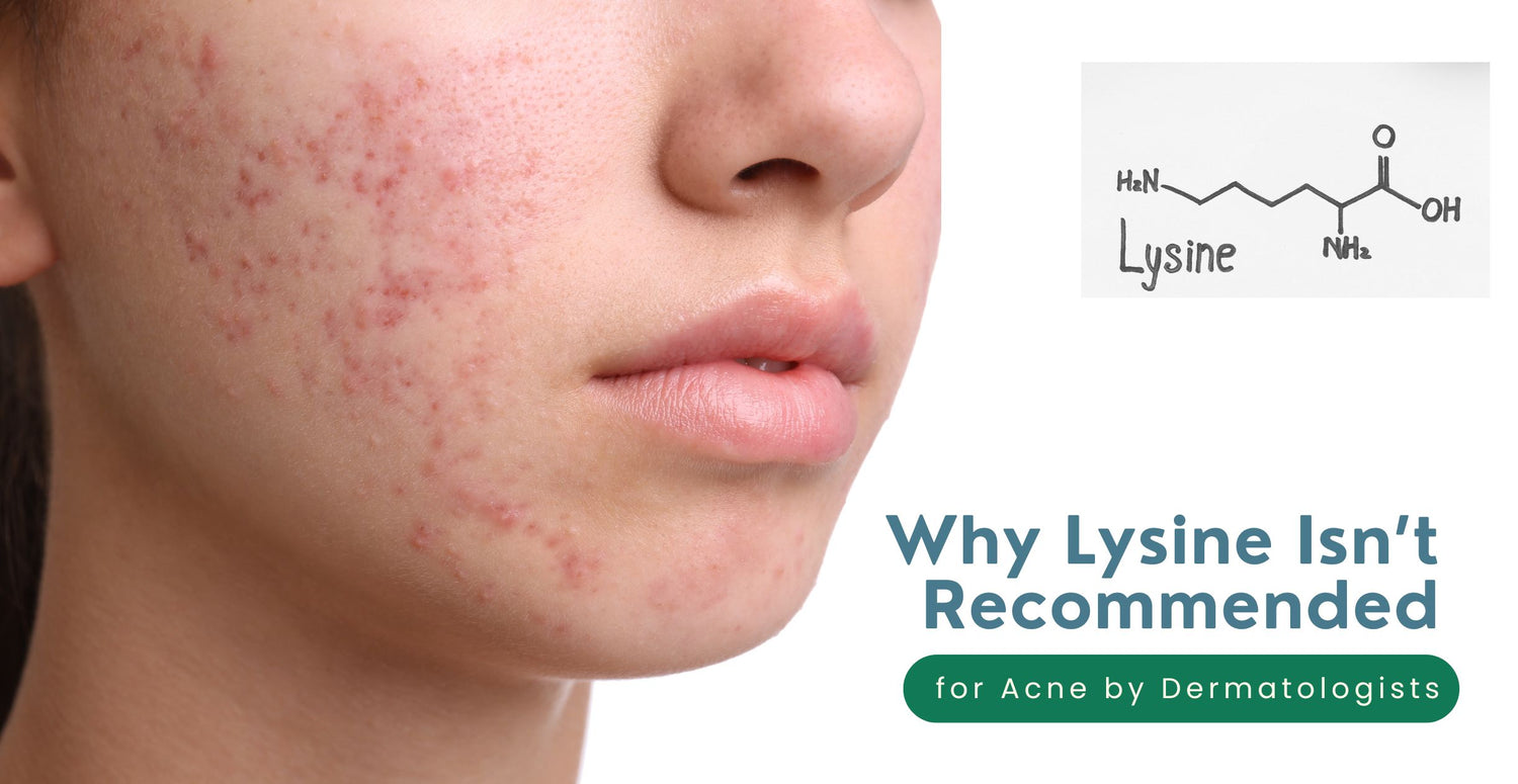 Why Lysine Isn’t Recommended for Acne by Dermatologists