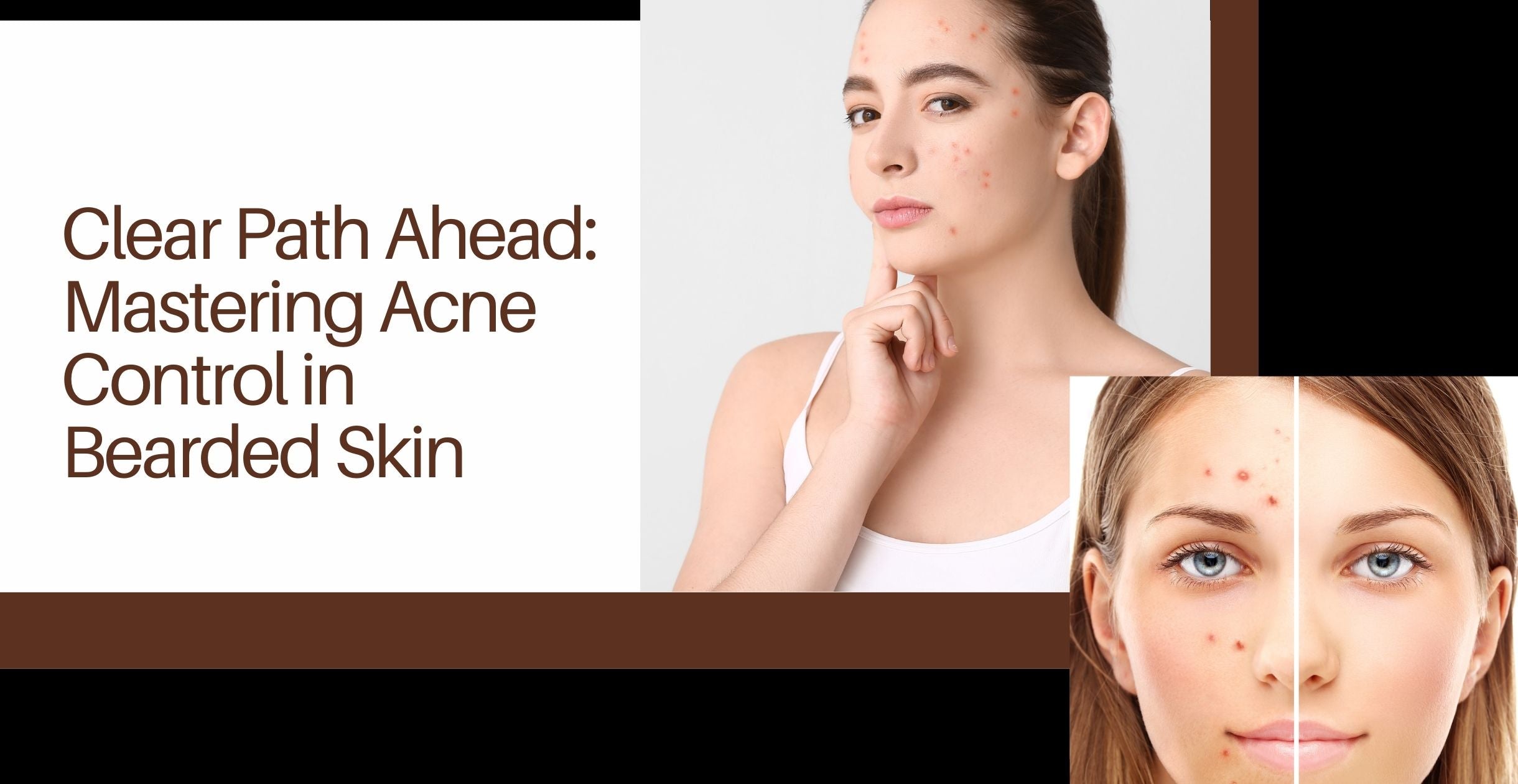 Clear Path Ahead: Mastering Acne Control in Bearded Skin