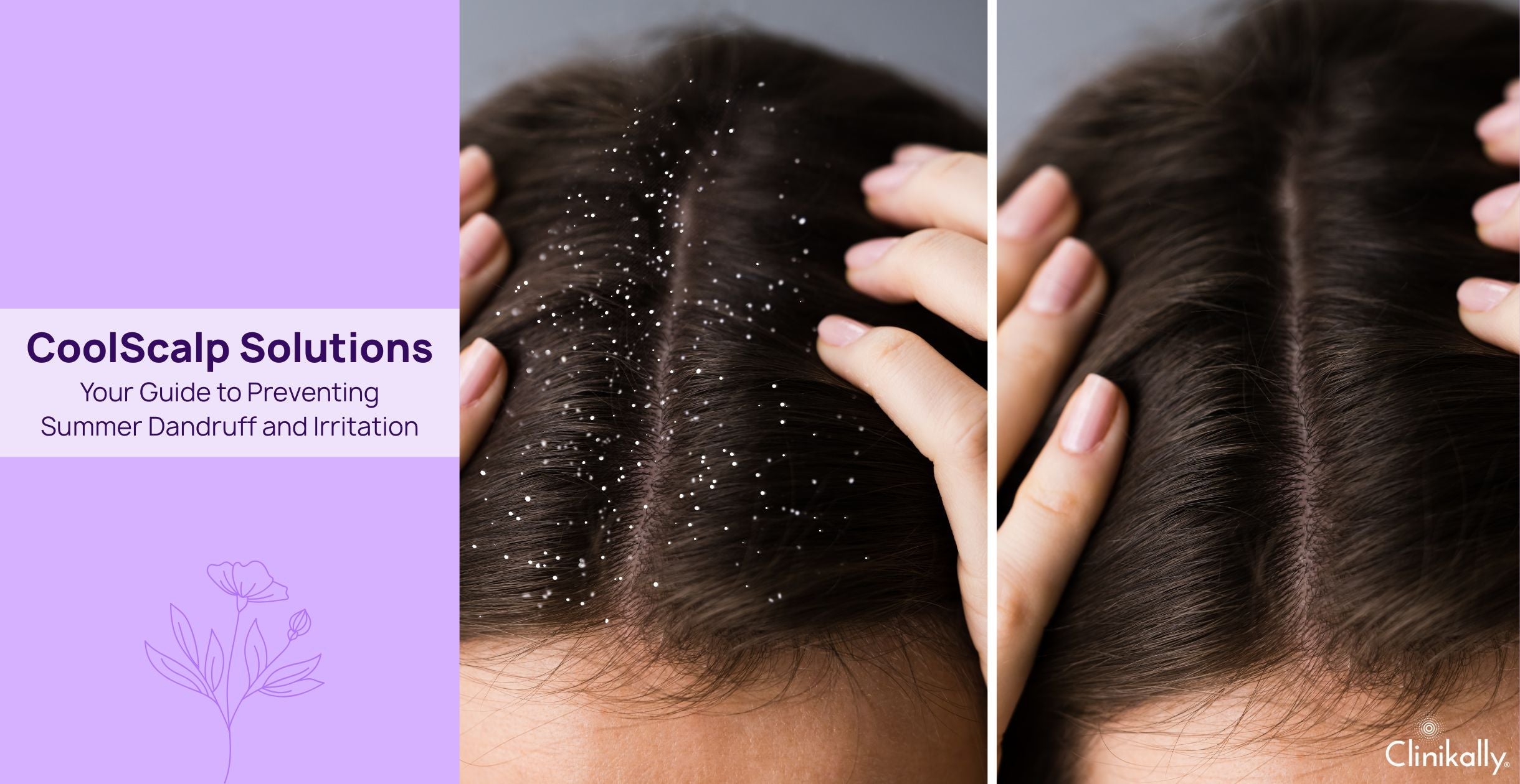 CoolScalp Solutions: Your Guide to Preventing Summer Dandruff and Irritation