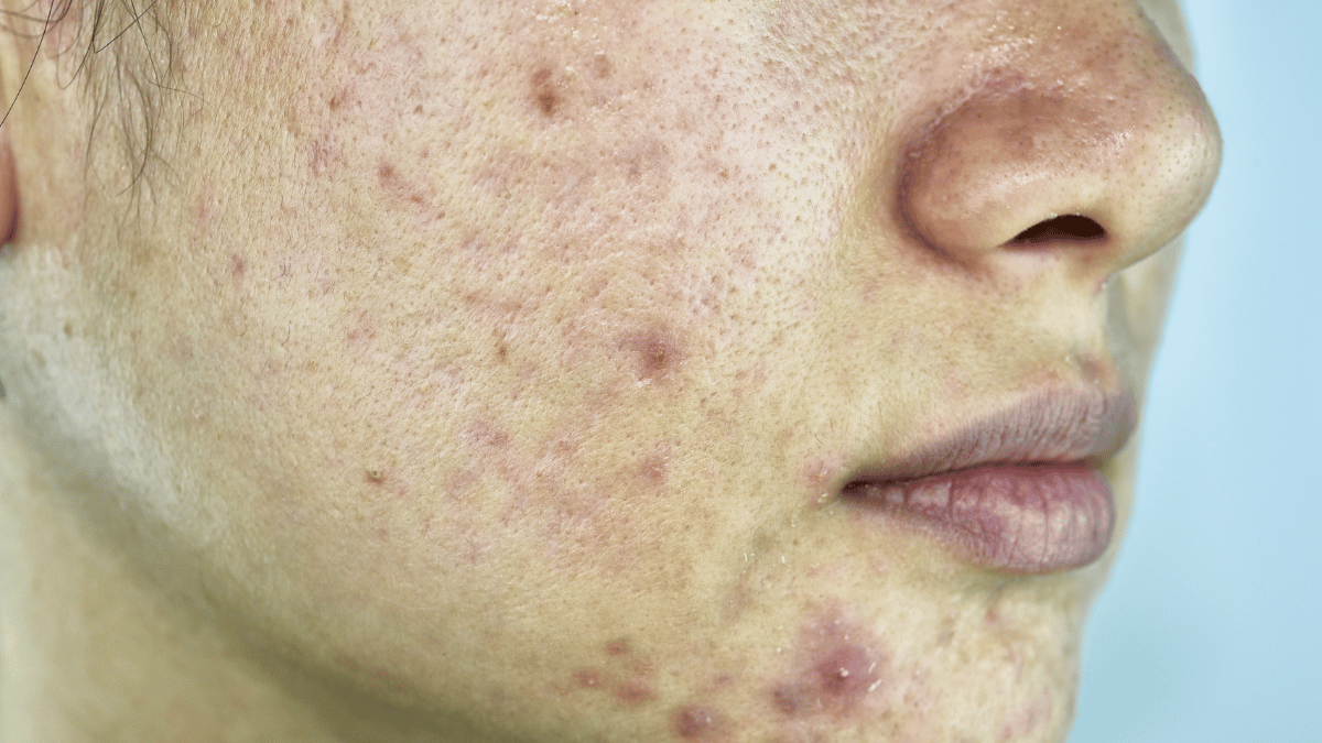 glycolic acid acne treatment