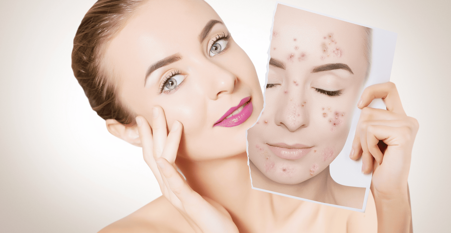 What Your Acne Reveals About Your Overall Health