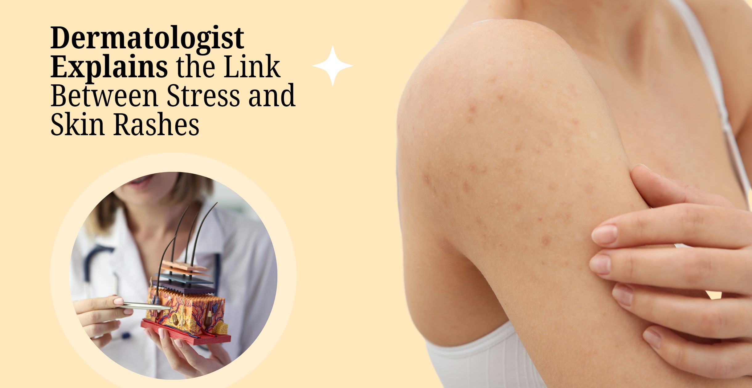 Dermatologist Explains the Link Between Stress and Skin Rashes