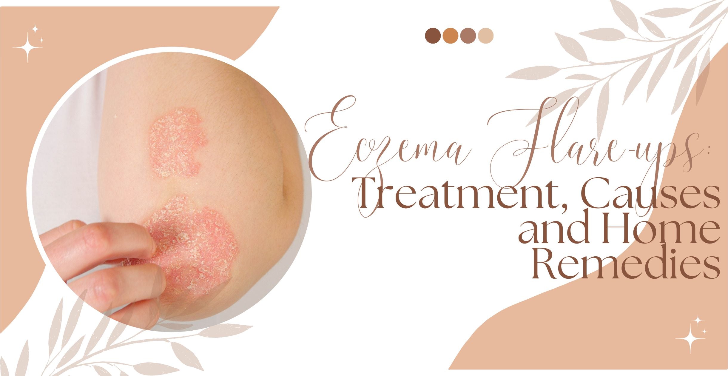 Eczema Flare-ups: Treatment, Causes and Home Remedies