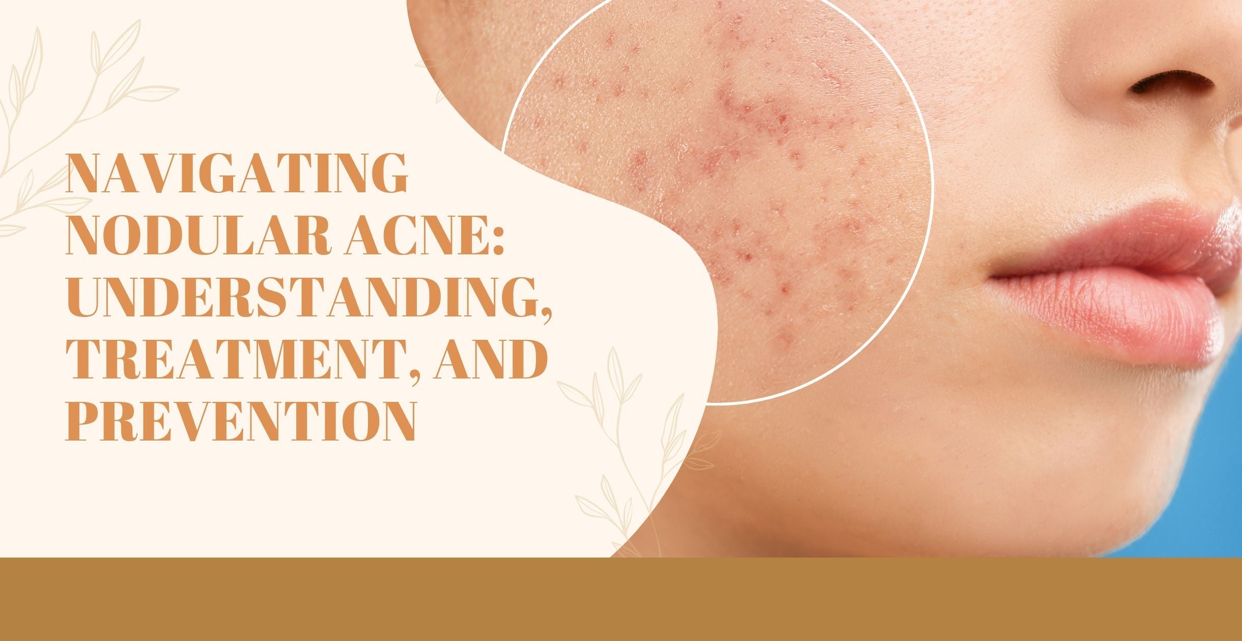 Navigating Nodular Acne: Understanding, Treatment, and Prevention