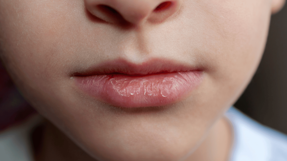 dry skin around your mouth