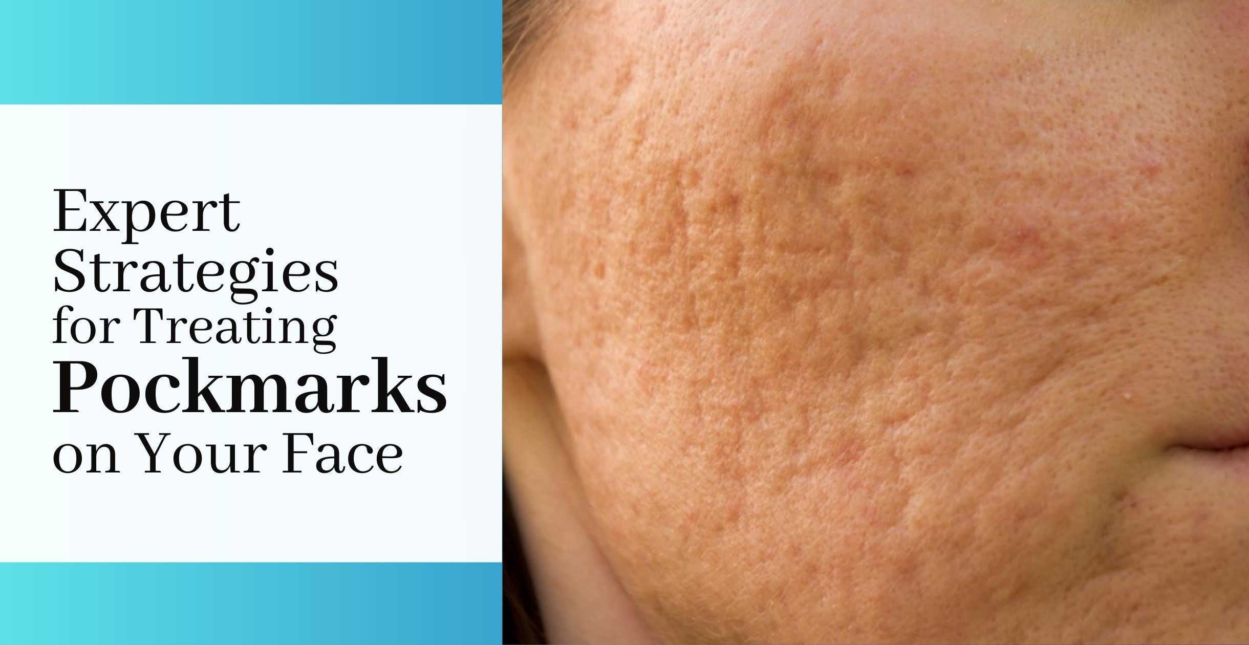 Expert Strategies for Treating Pockmarks on Your Face