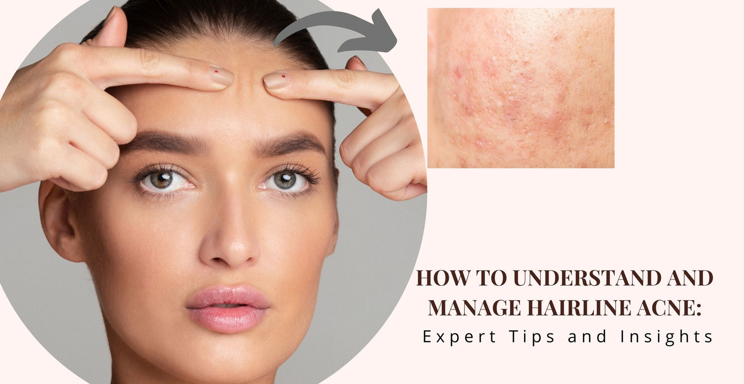 How to Understand and Manage Hairline Acne: Expert Tips and Insights