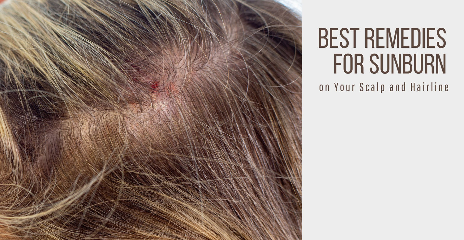 Best Remedies for Sunburn on Your Scalp and Hairline