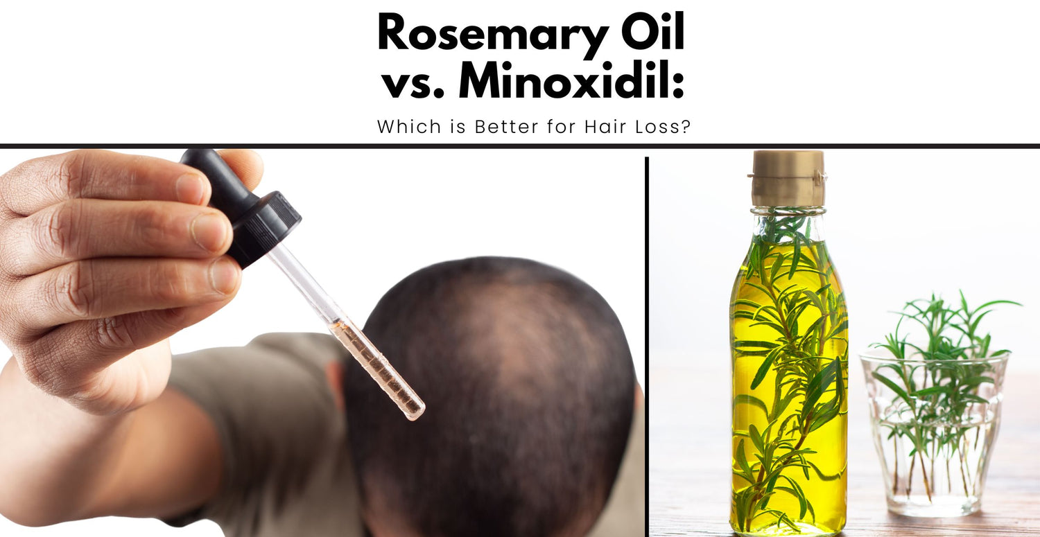 Rosemary Oil vs. Minoxidil: Which is Better for Hair Loss?