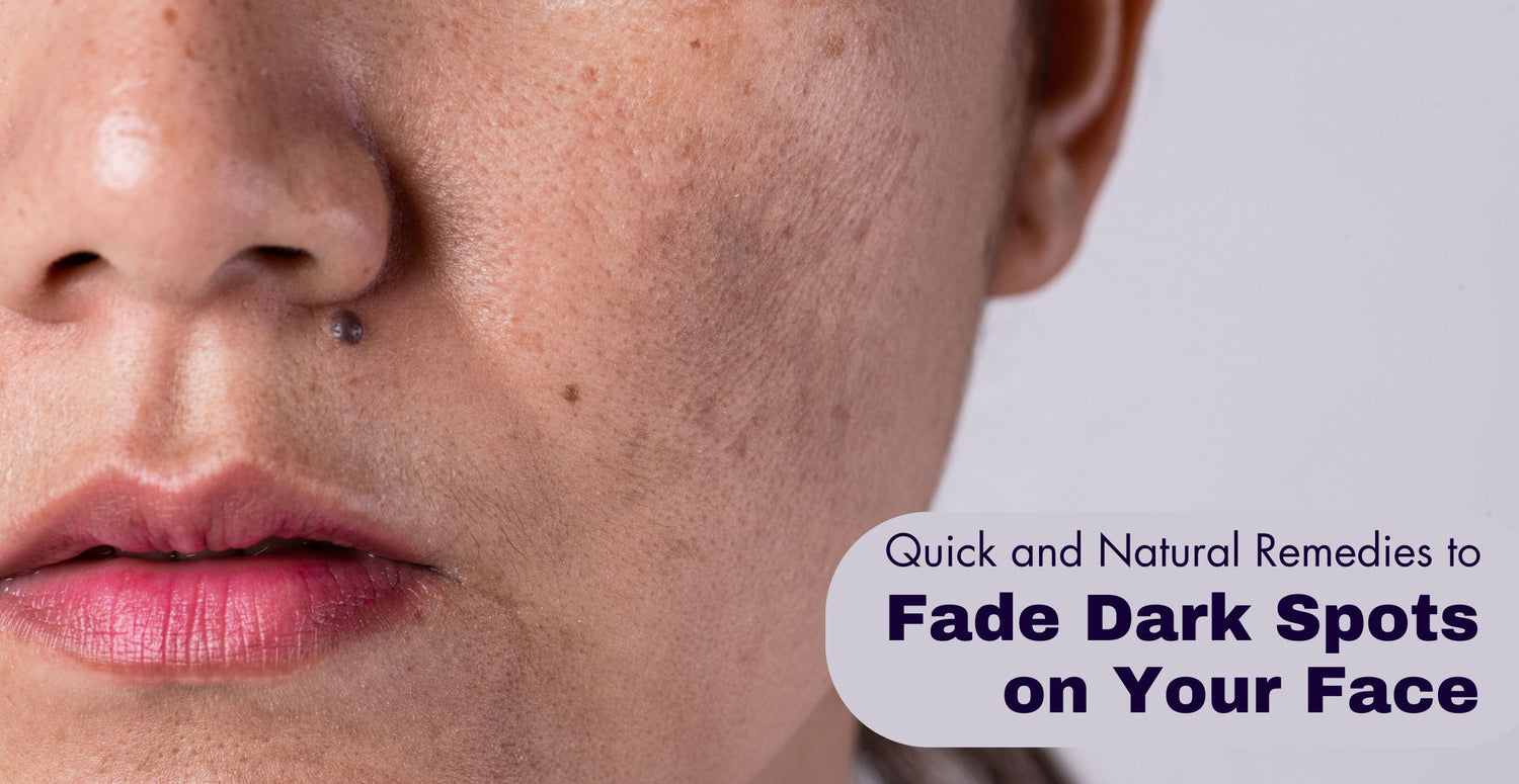 Quick and Natural Remedies to Fade Dark Spots on Your Face