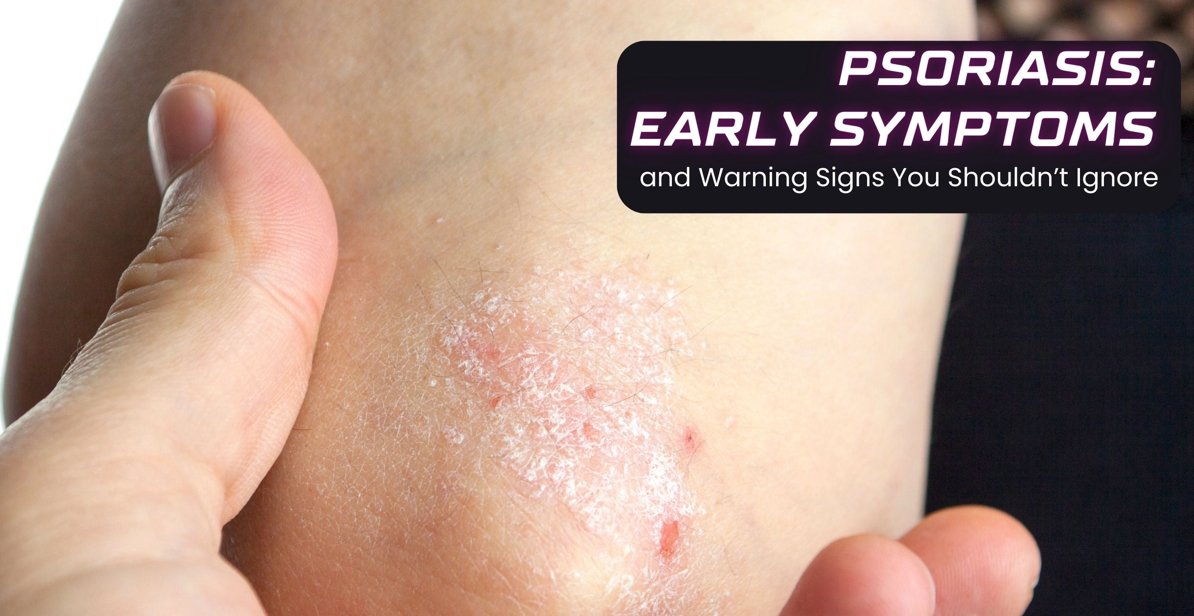 Psoriasis: Early Symptoms and Warning Signs You Shouldn’t Ignore