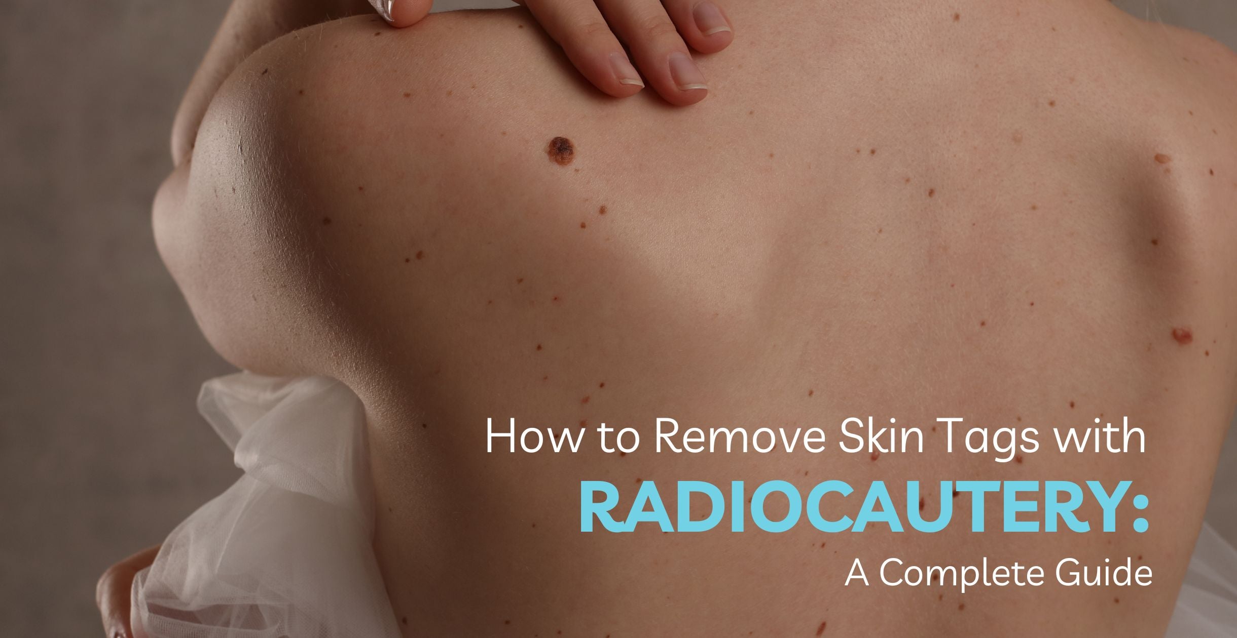 How to Remove Skin Tags with Radiocautery: A Complete Guide