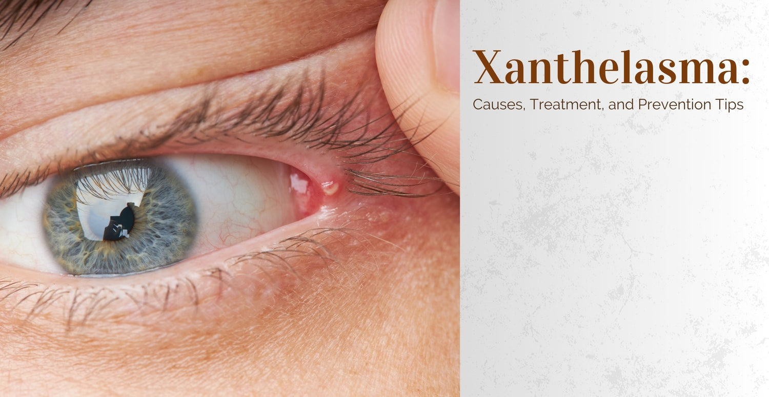 Xanthelasma: Causes, Treatment, and Prevention Tips