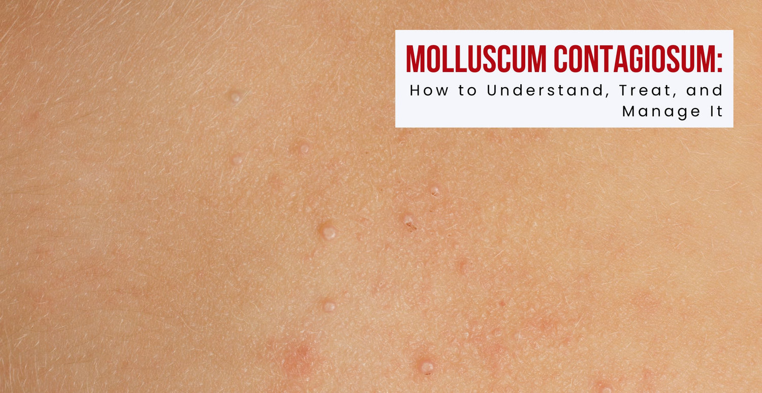 Molluscum Contagiosum: How to Understand, Treat, and Manage It