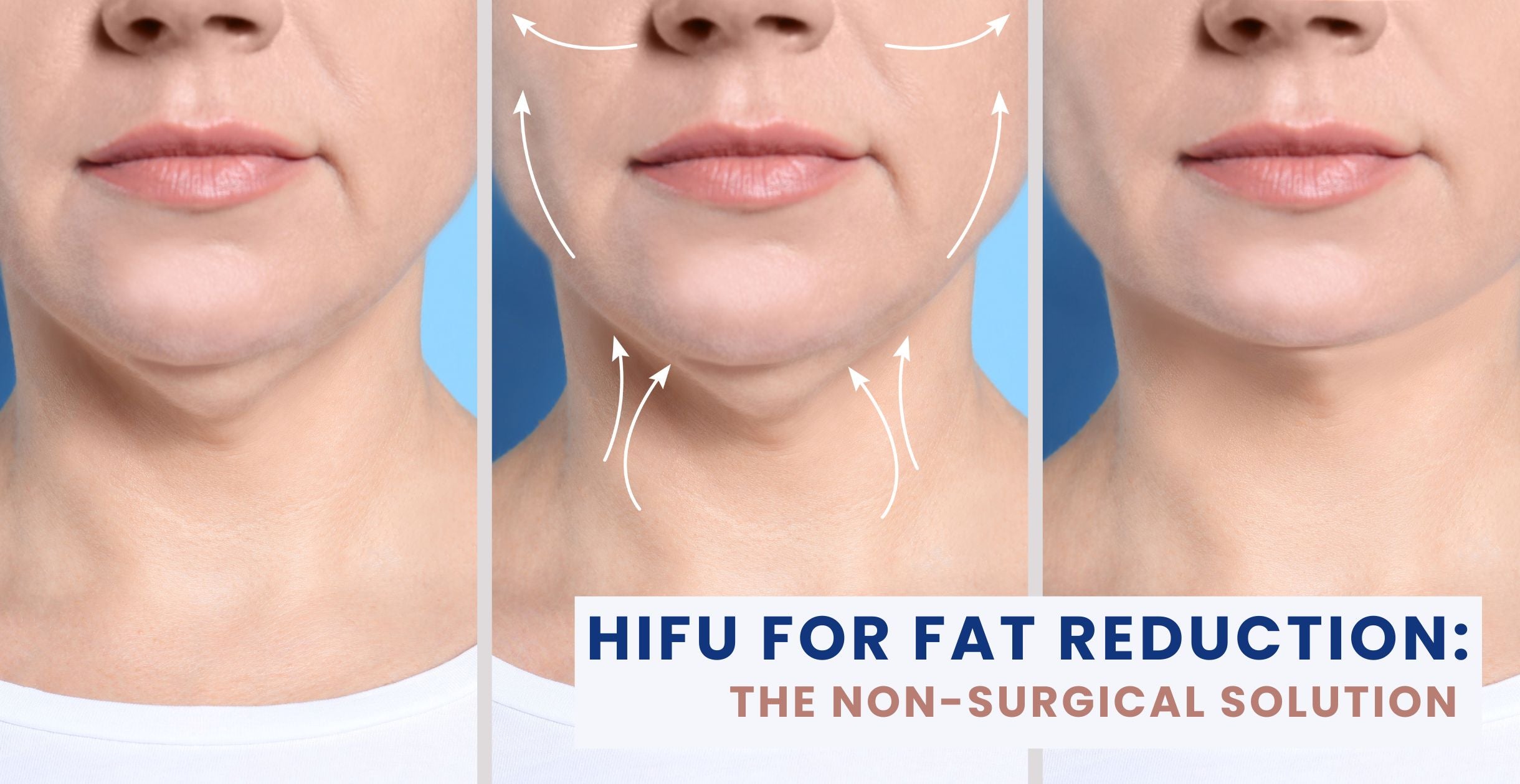 HIFU for Fat Reduction: The Non-Surgical Solution You Need to Know About