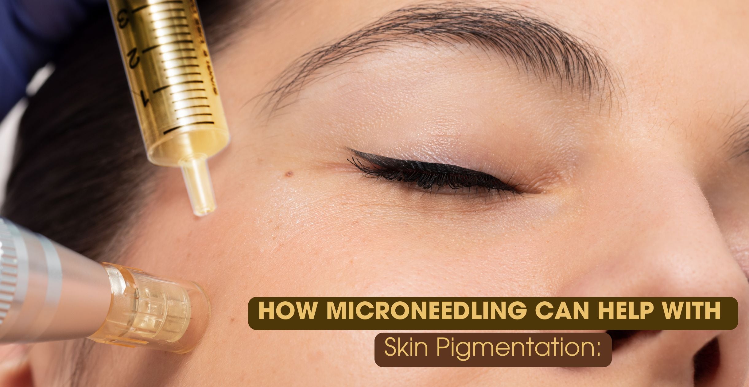 How Microneedling Can Help with Skin Pigmentation: What’s New and Why It Works