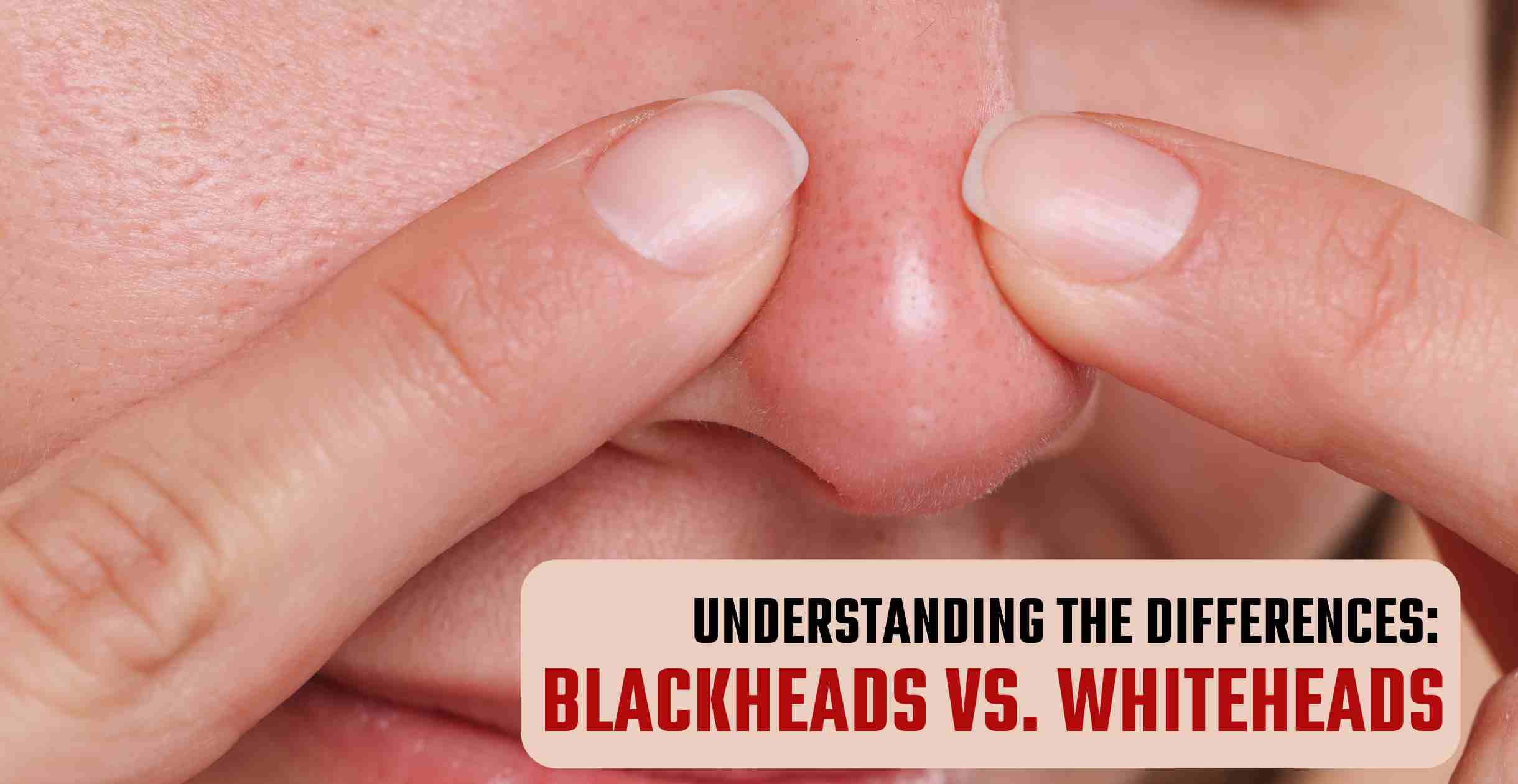 Understanding the Differences: Blackheads vs. Whiteheads