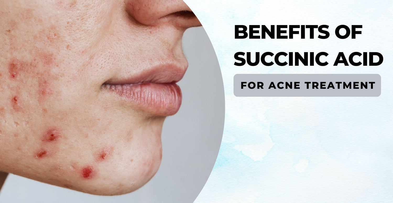 Benefits of Succinic Acid for Acne Treatment