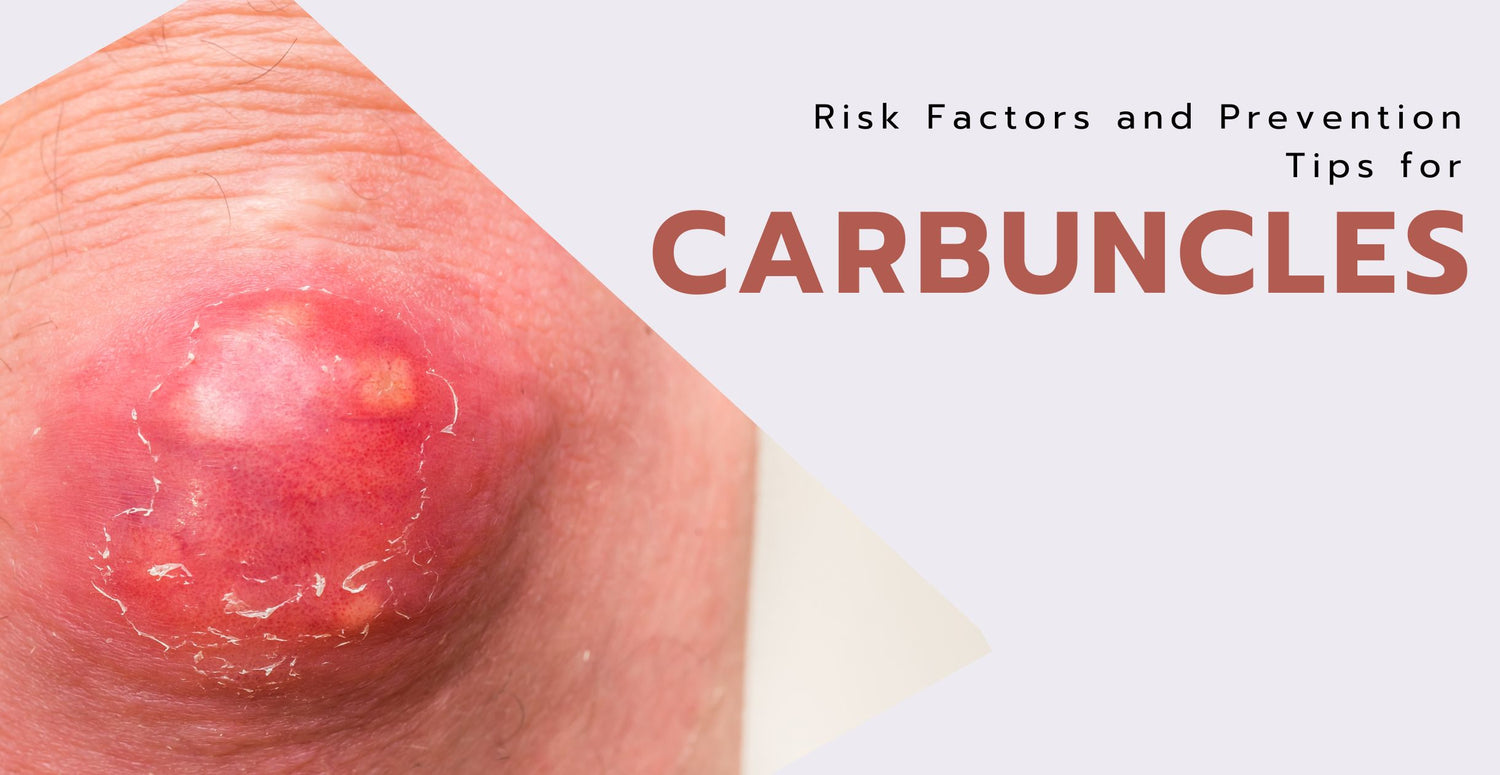 Risk Factors and Prevention Tips for Carbuncles