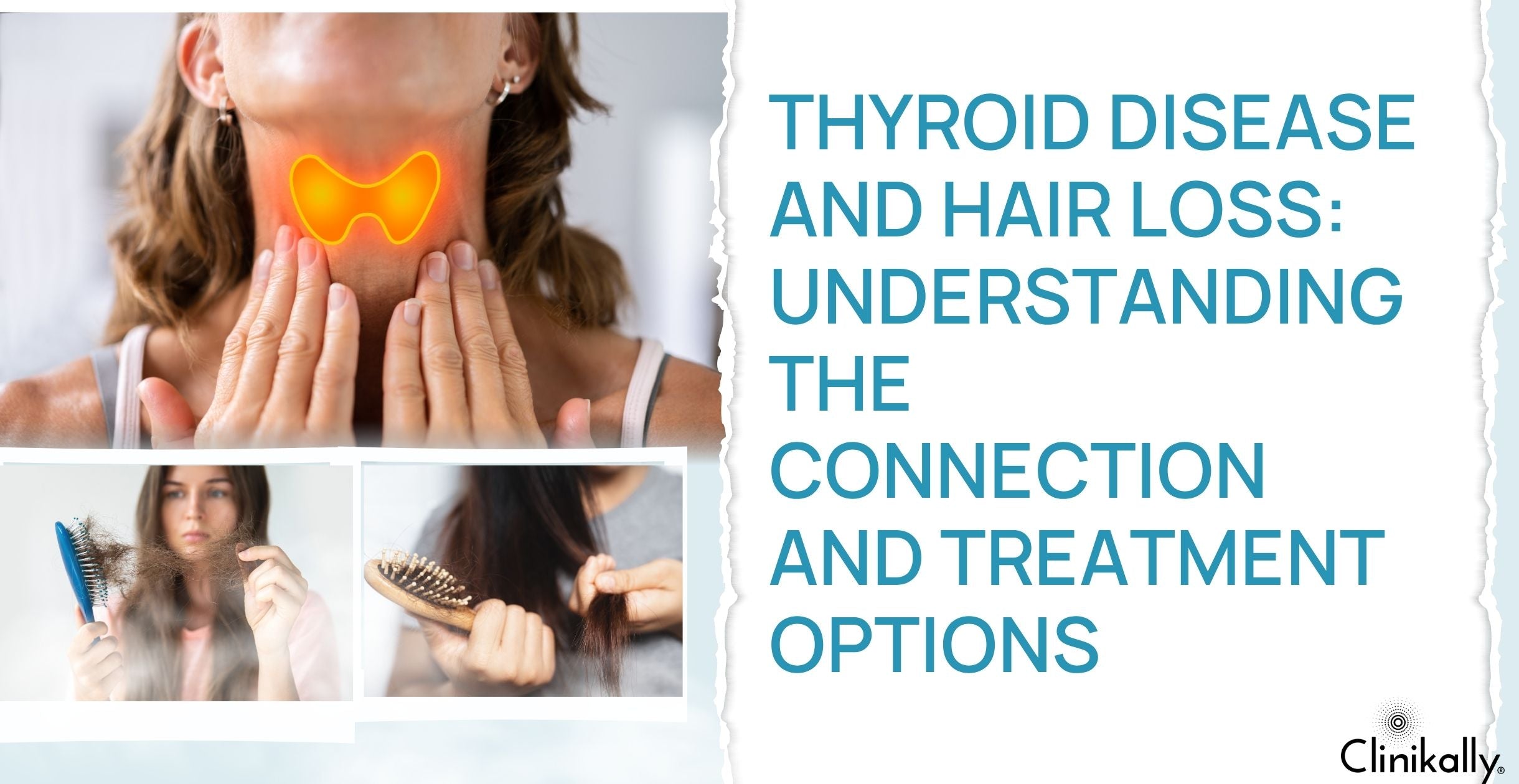 Thyroid Disease and Hair Loss: Understanding the Connection and Treatment Options