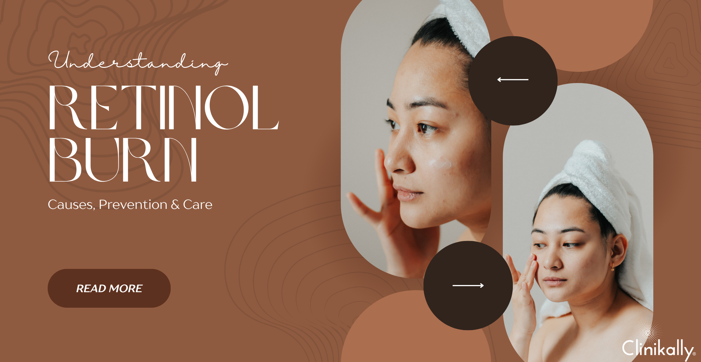 Understanding Retinol Burn: Causes, Prevention, and Care