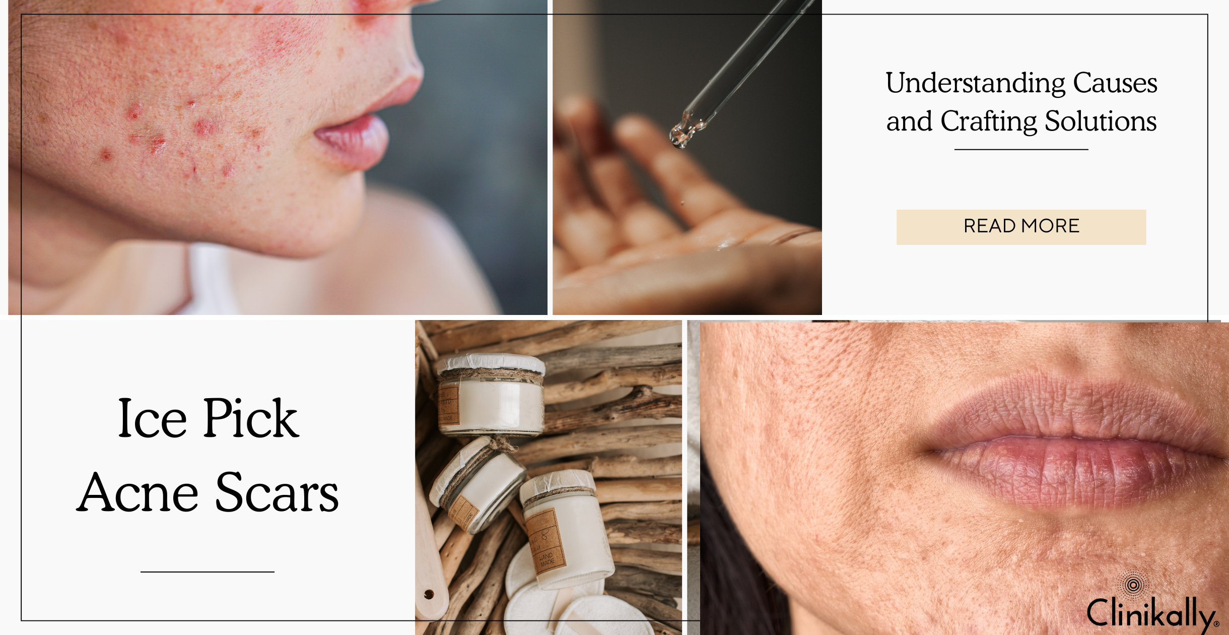 Ice Pick Acne Scars: Understanding Causes and Crafting Solutions