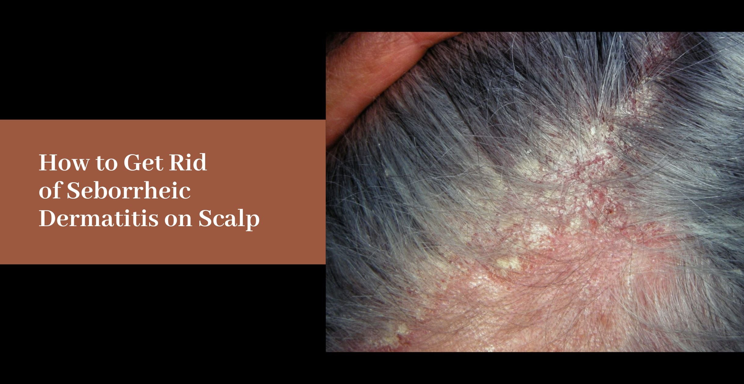 seborrheic dermatitis scalp