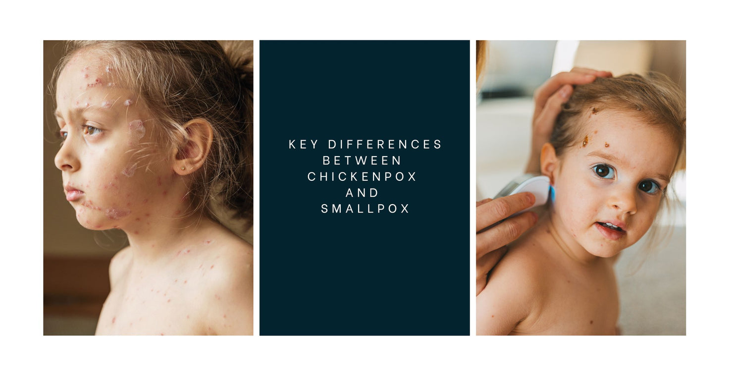 Key Differences Between Chickenpox and Smallpox