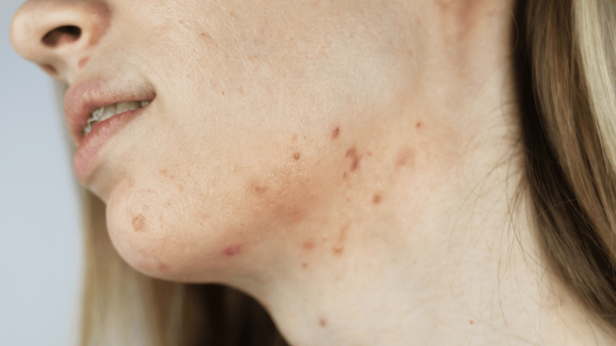 How to get rid of acne on your neck