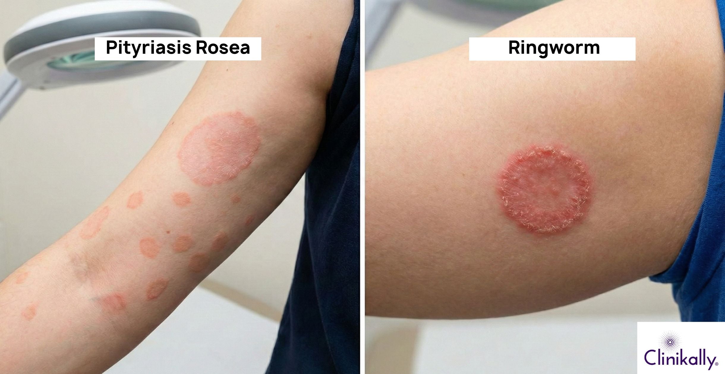 Pityriasis Rosea vs Ringworm