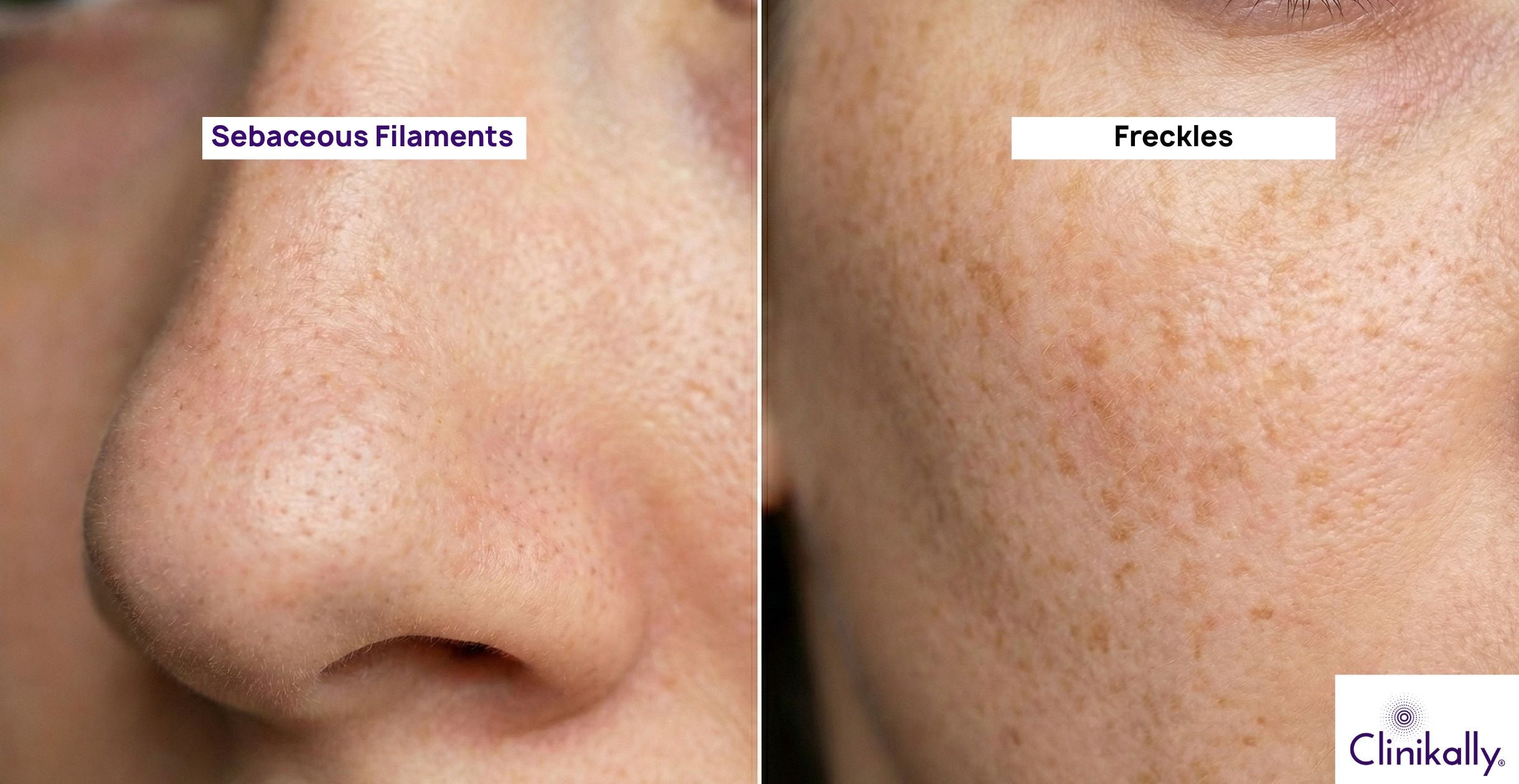 Sebaceous Filaments vs Freckles How to Tell the Difference