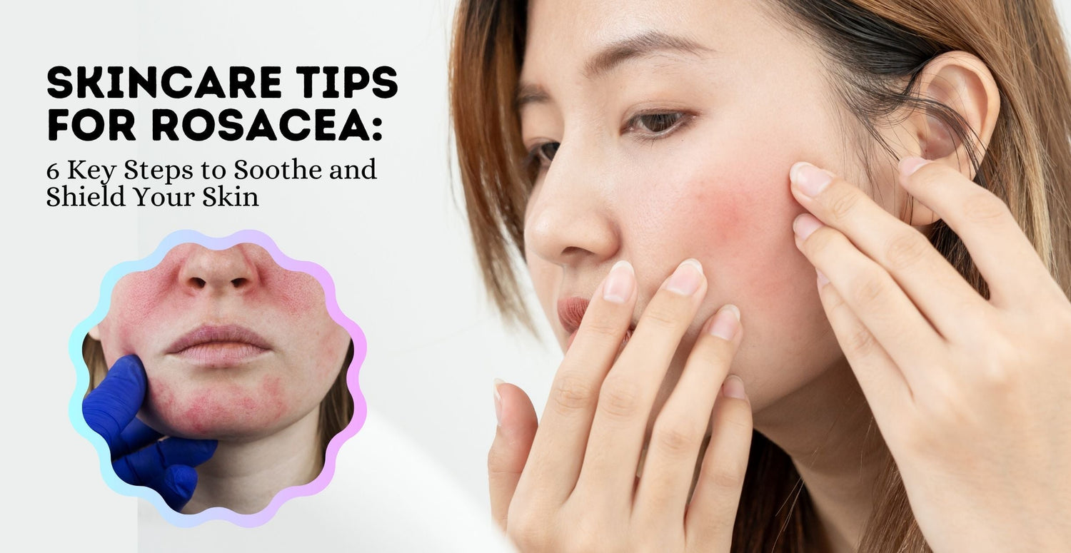 Skincare Tips for Rosacea: 6 Key Steps to Soothe and Shield Your Skin