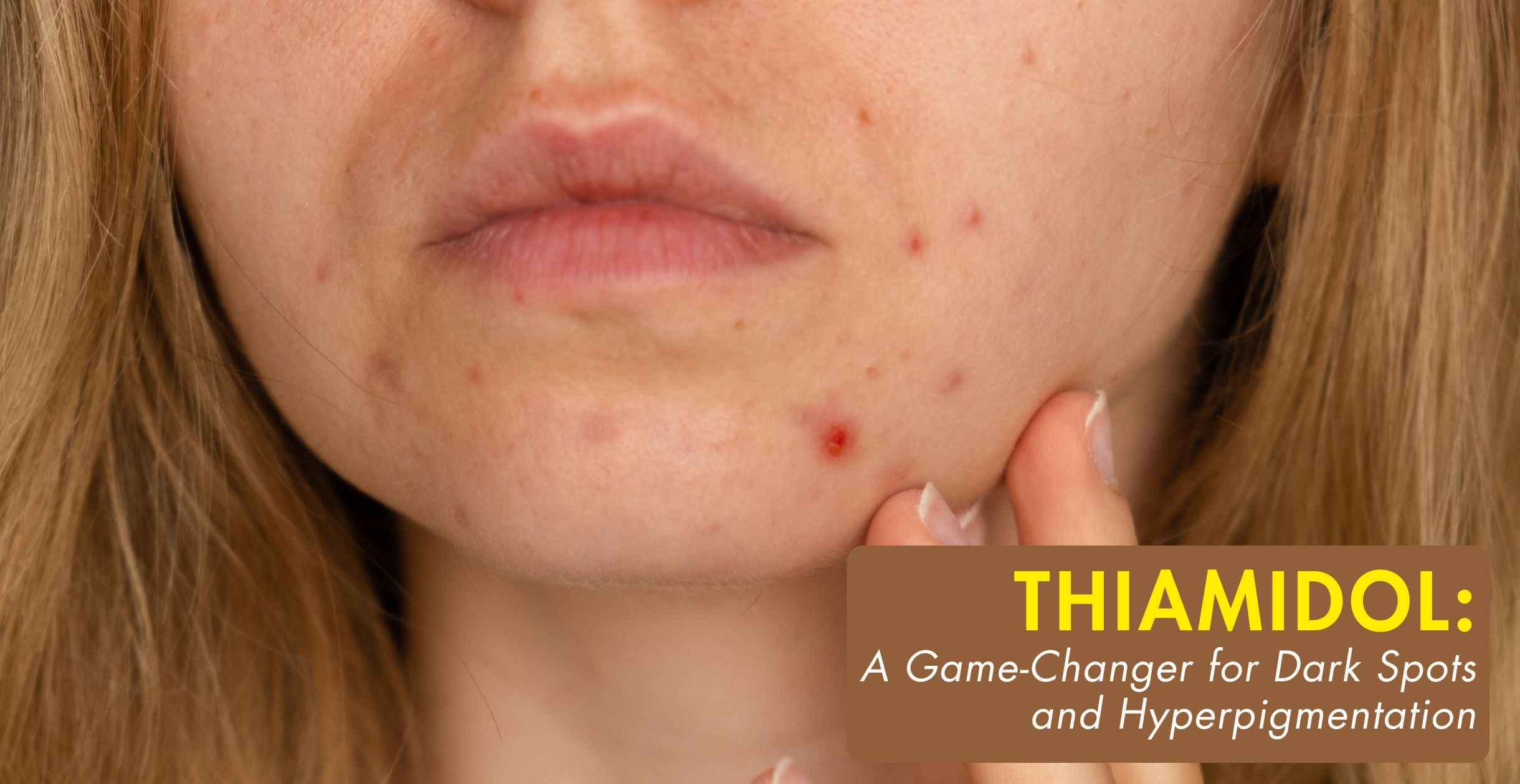 A Game-Changer for Dark Spots and Hyperpigmentation