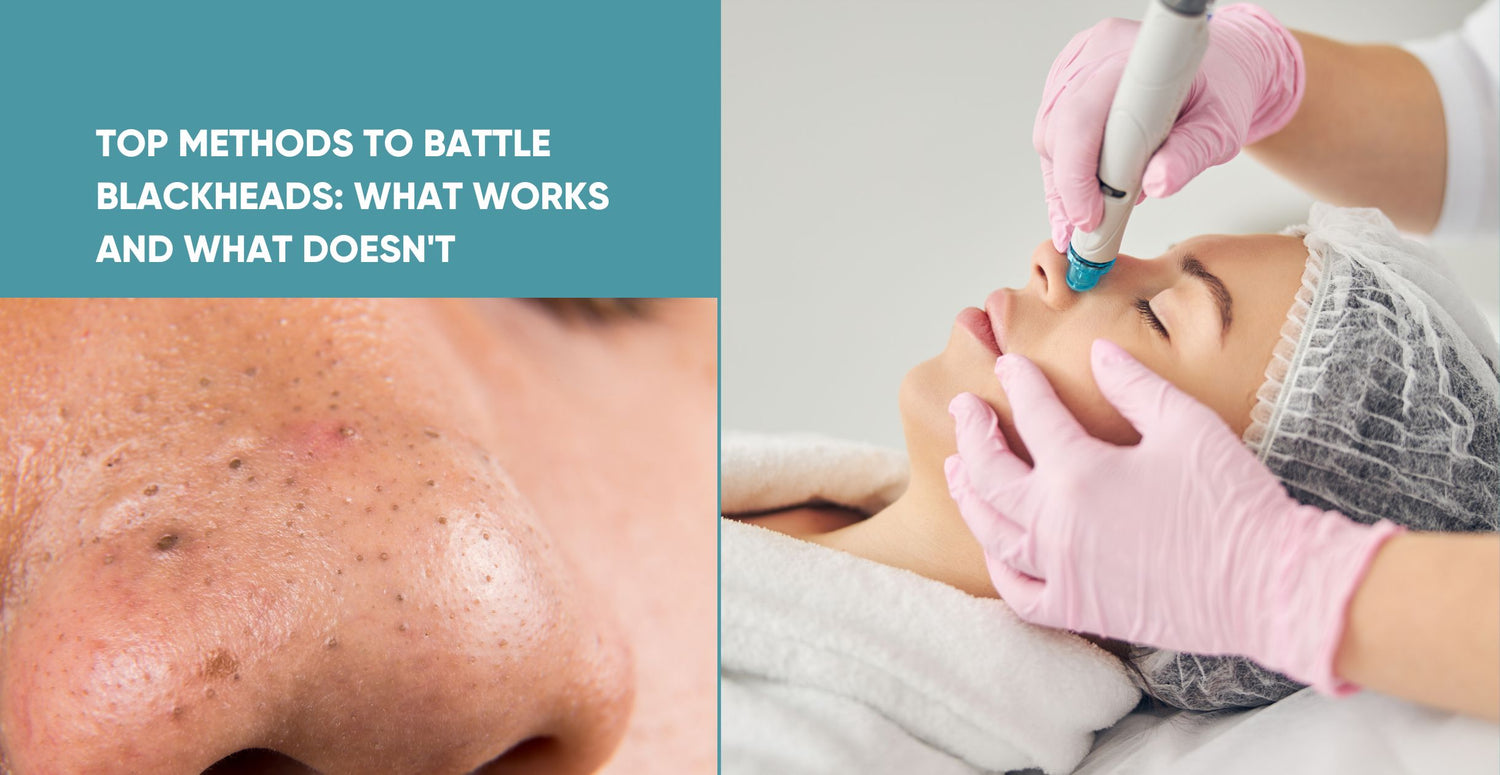 Top Methods to Battle Blackheads: What Works and What Doesn't
