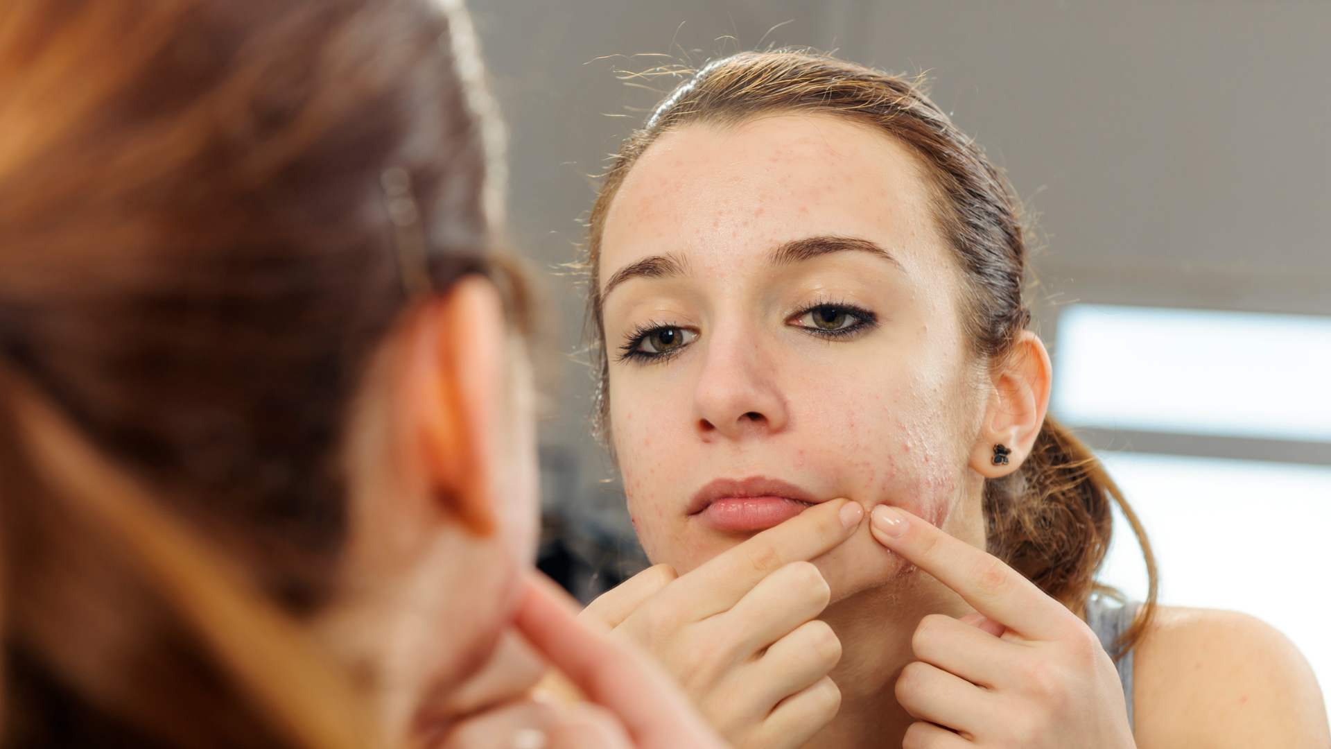 benzoyl peroxide for acne 