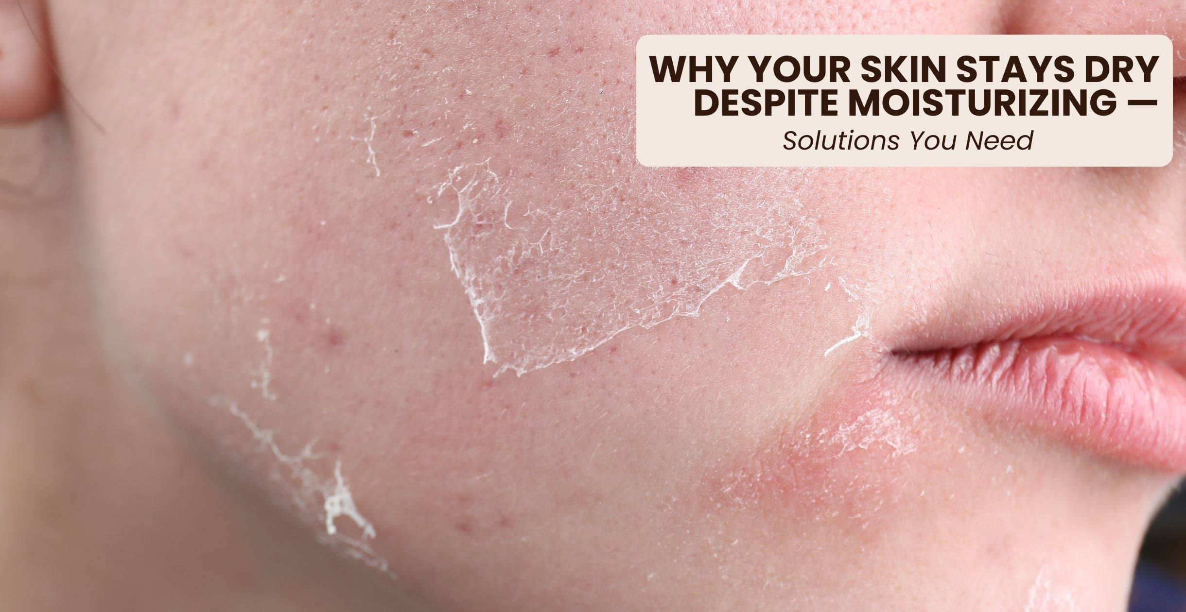 Why Your Skin Stays Dry Despite Moisturizing — Solutions You Need