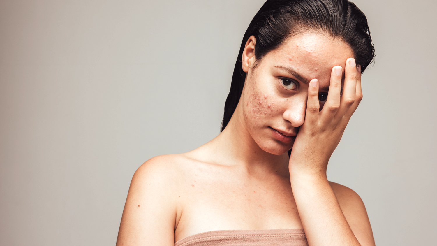 Body Acne Types, Treatment, and How to Prevent: Doctor's Guide | Clinikally